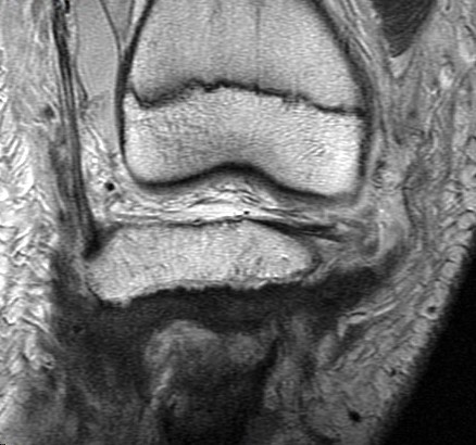 Figure 3 for case Salter type IV fracture ( RID4688 )